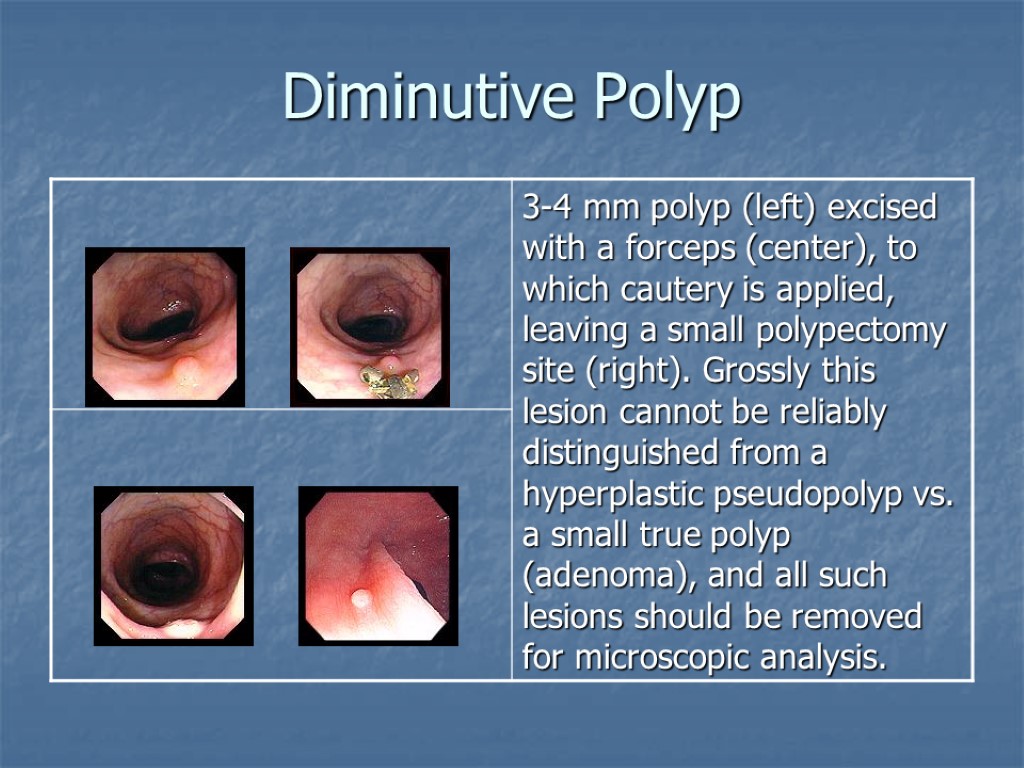 Diminutive Polyp